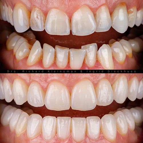 Complete restoration of upper and lower jaw with veneers and facelays! Result: the ultimate natural smile!...