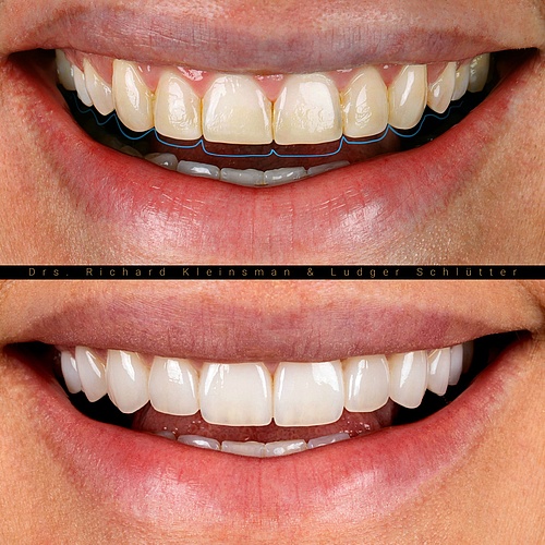 12 non - prep veneers for a natural smile! . . Dentist: @drs.richardkleinsman Technician: @ludgerschluetter . . 📸:...