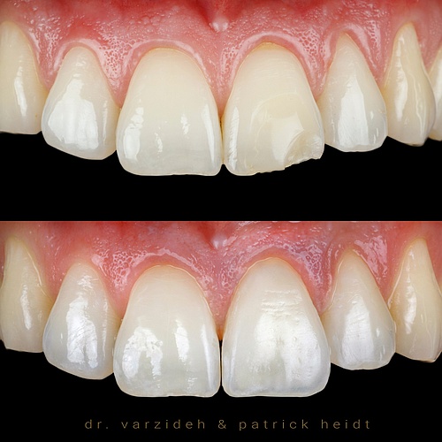 Single additional veneer - looks easy, but indeed challenging, specially for the dental technician. . . Dentist:...