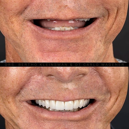 Years of grinding, broken fillings, discoloration, and hidden decay had completely changed this smile and bite... Years of grinding, broken fillings, discoloration, and hidden decay had completely changed this smile and bite...