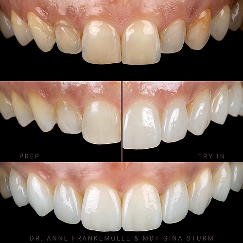 10 minimal prep veneers for upper jaw to make it look beautiful but natural. . . Dentist: @annefrankemolle Technician:...