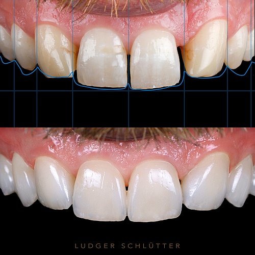 Non prep veneers from 16-26 to create more harmony. For this result the canines were transformed into laterals and the...