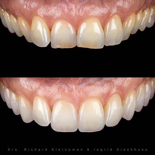 2 non-prep veneers to enhance shape and color for this 45-year-old patient. The fuller smile was designed to support...