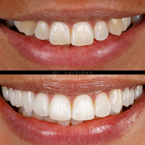 Veneers in the upper jaw… . . Dentist: @dr.varzideh . . 📸: @eden_dental_photography . #dentalveneers #dentalphotos...
