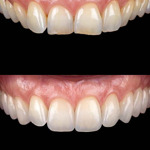 12 ultra-thin veneers. 0.4 mm of porcelain. Nothing artificial-looking.
For this 50-year-old patient, the goal was... 12 ultra-thin veneers. 0.4 mm of porcelain. Nothing artificial-looking.
For this 50-year-old patient, the goal was...