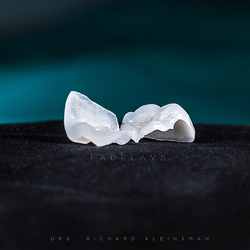 FACELAY = veneer + onlay . . Dentist: @drs.richardkleinsman Technician: @ingriddieckhues . . 📸:...