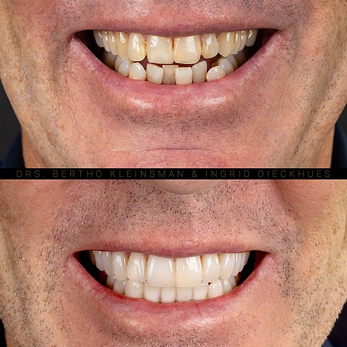 20 veneers in total. . . Dentist: @berthokleinsman Dental Technician: @ingriddieckhues . . 📸:... 20 veneers in total. . . Dentist: @berthokleinsman Dental Technician: @ingriddieckhues . . 📸:...