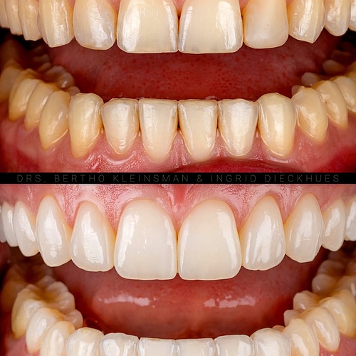 A subtle change with a big impact. This smile makeover was done with veneers from upper jaw 16–26 and lower jaw 35–45 —... A subtle change with a big impact. This smile makeover was done with veneers from upper jaw 16–26 and lower jaw 35–45 —...
