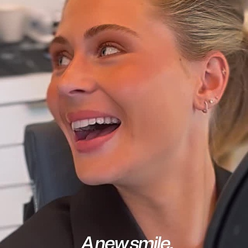 POV: Minimal prep. Maximum precision.✨ Non-prep veneers may look effortless in the final reveal.
In reality, every... POV: Minimal prep. Maximum precision.✨ Non-prep veneers may look effortless in the final reveal.
In reality, every...
