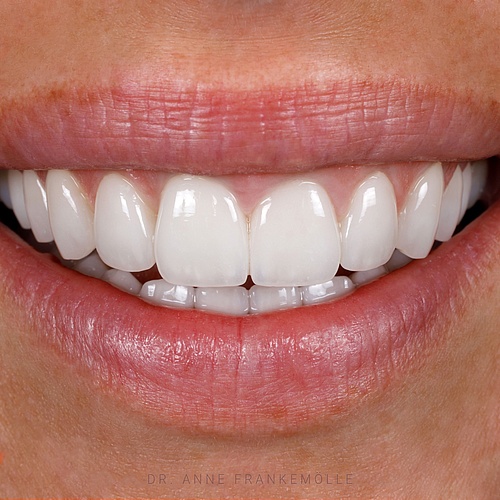 A more elegant and feminine smile. Each tooth should be considered individually in order to maximise stability,...