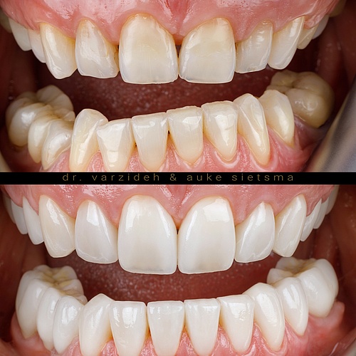 Not the easiest one… Full upper und lower arch (@dr.varzideh) . . Dentist: @dr.varzideh Technician: @aukesietsma . ....