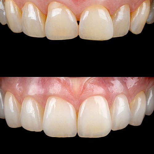 Here we go again.
8 non prep veneers to change the whole look.
The total treatment will create a natural and fresh... Here we go again.
8 non prep veneers to change the whole look.
The total treatment will create a natural and fresh...