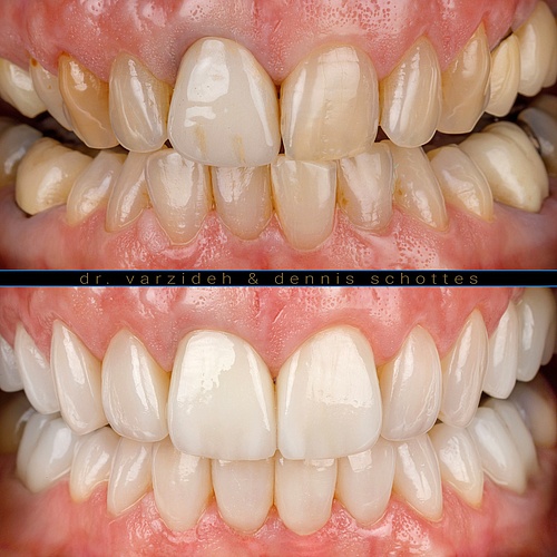 Minimal invasive in combination with gum transplant. Total makeover of lower and upper jaw. (@dr.varzideh) . . Dentist:...