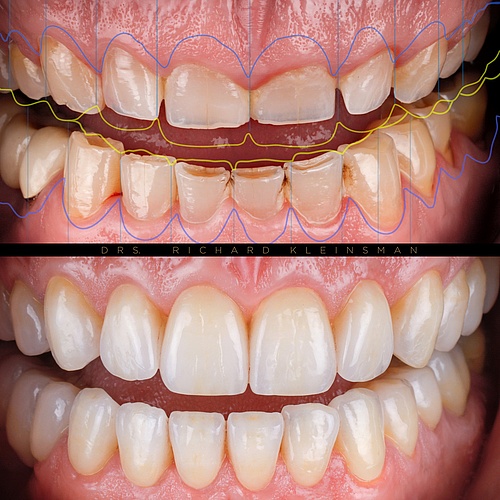 Total renovation: Upper and lower jaw 24 full ceramic crowns. . . Technician: @ingriddieckhues Dentist:...