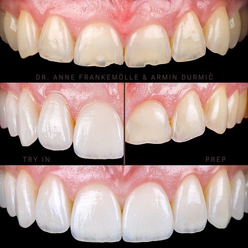 Restoration of length, shape, function and aesthetics after massive loss of substance due to parafunction and grinding....