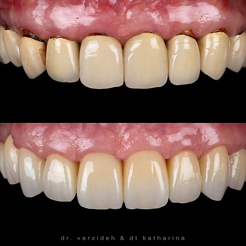 Bring back healthy gingiva… Bring back healthy gingiva…