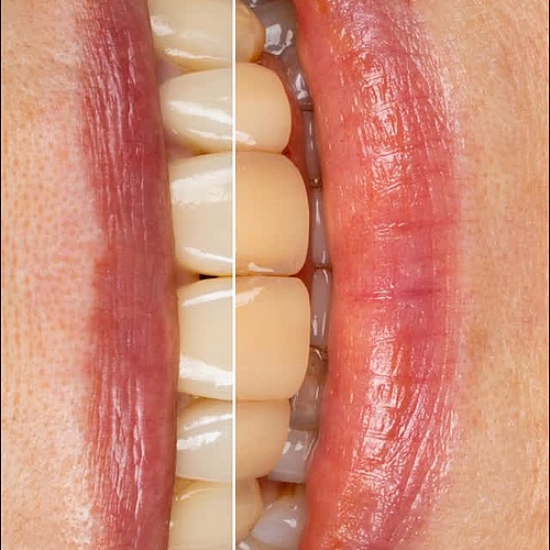 A refined transformation with veneers & veneerlays — crafted to elevate natural beauty with minimal invasiveness. A...