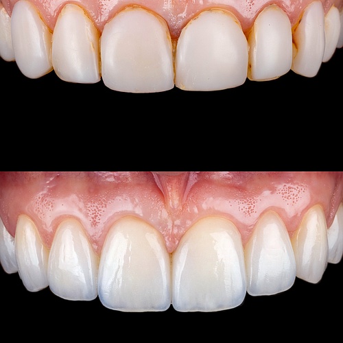 Transforming smile in just two appointments!
We removed old composite Veneers and replaced them with handcrafted... Transforming smile in just two appointments!
We removed old composite Veneers and replaced them with handcrafted...