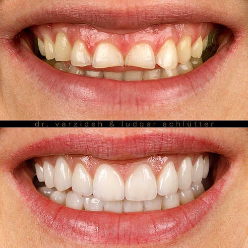 Starting with gum and bone correction in the upper jaw and placing veneers afterwards… (@dr.varzideh) . . Dentist:...