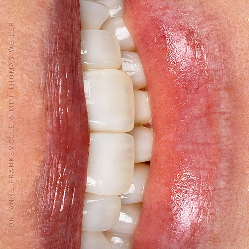 A smile is more than beauty—it is identity. For years, this patient held hers back. Not by choice, but because it no... A smile is more than beauty—it is identity. For years, this patient held hers back. Not by choice, but because it no...