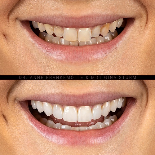 Unseen, yet noticed by all. Minimal invasive veneers (upper jaw) and teeth whitening (lower jaw). Say hello to a...