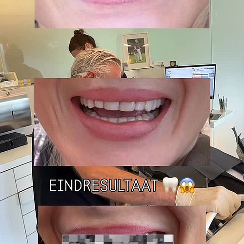 Deel 3 | Van gele tanden… naar composiet facings… naar eindelijk mijn droomgebit met No Prep Veneers 😭🦷 Vandaag zag ik...