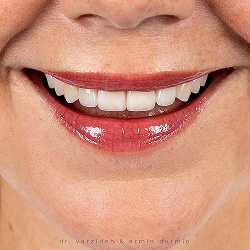 Final esthetic rehabilitation using minimally invasive veneers to harmonize shape, brightness, and smile dynamics.... Final esthetic rehabilitation using minimally invasive veneers to harmonize shape, brightness, and smile dynamics....