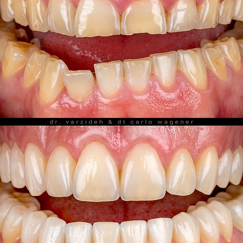 This patient wanted to get a nice smile after years of bruxism. Complete makeover with veneers in the upper and lower... This patient wanted to get a nice smile after years of bruxism. Complete makeover with veneers in the upper and lower...