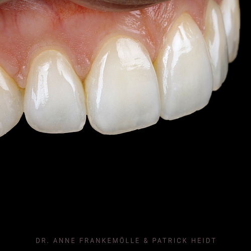 It‘s all about details (@annefrankemolle) . . Dentist: @annefrankemolle Technician: @patrick.heidt . . 📸:...