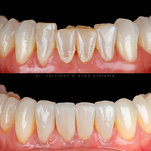 Dental veneers and crowns for an aesthetic upgrade of the lower jaw. . . Dentist: @dr.varzideh Dental Technician:...