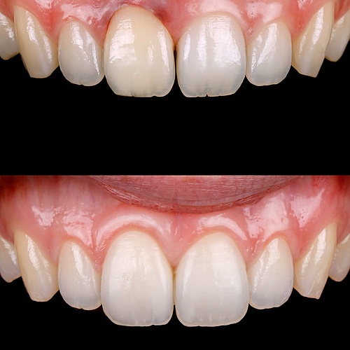 A subtle transformation with meaningful impact ✨ Two anterior veneers (11 & 21) were placed to restore harmony and...