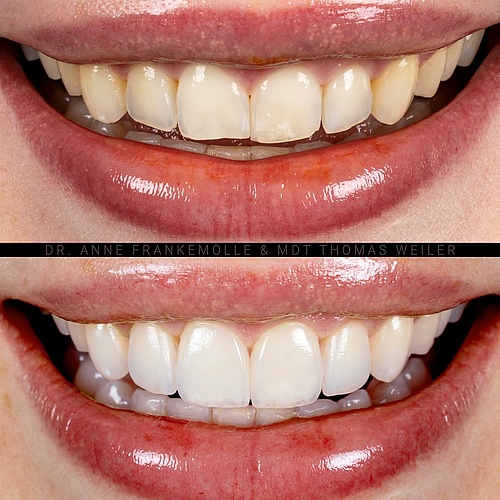 Outstanding esthetics, maximum naturalness – No-Prep Veneers create a flawless smile without altering your natural...