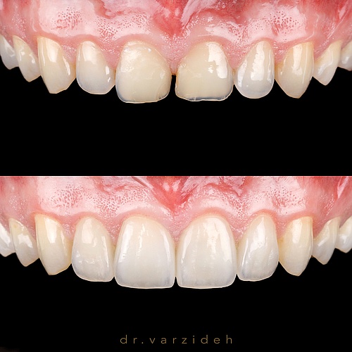4 non prep veneers Closing space Create form and harmony No damage . . Dentist: @dr.varzideh Technician:...