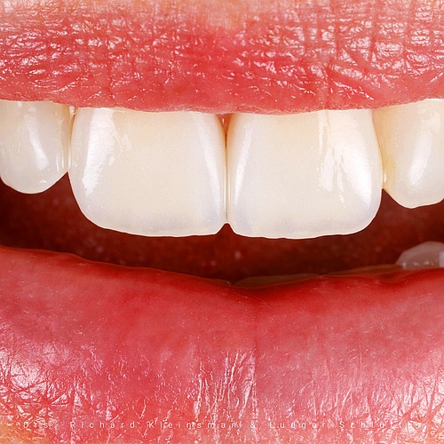As always. Trying to come to a natural result. In this case veneers on refractory. . . Creation CC Dentist:...
