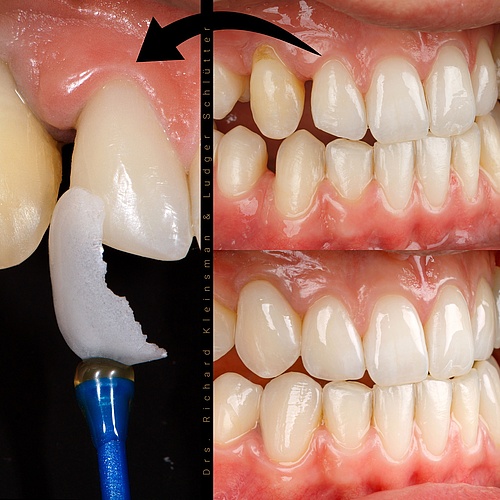 12 non - prep veneers -> very thin 0,3-0,5mm! . . Dentist: @drs.richardkleinsman Technician: @anjakruessmann . . 📸:...