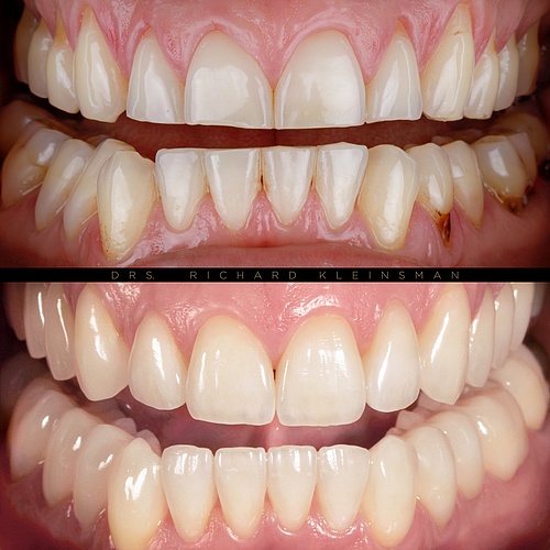 Total renovation; 28 additional ceramic veneers and onlays. . . Dentist: @drs.richardkleinsman Technician:...
