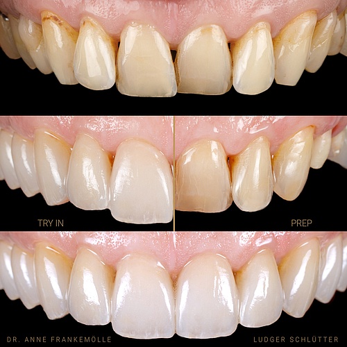 Journey of a smile Front with almost prepless veneers, sides with crowns. And take a look at the gums that make them...