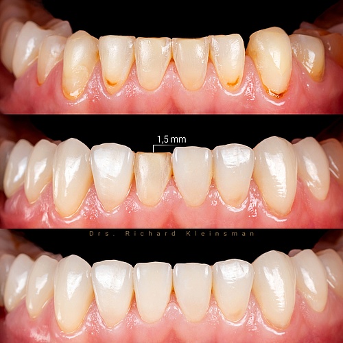 Bite lift!! Just build up the teeth with 6 veneers and 8 facelays! . . Dentist: @drs.richardkleinsman Technician :...