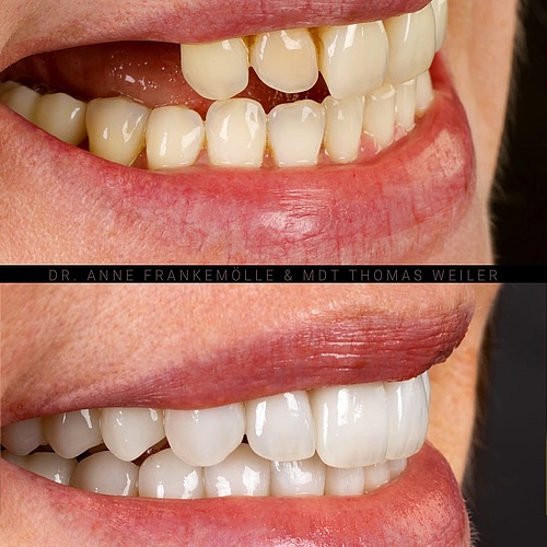 A smile is more than beauty—it is identity. For years, this patient held hers back. Not by choice, but because it no...