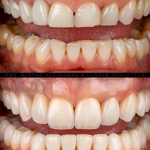 A full smile rehabilitation with function and aesthetics in balance. The bite was rebuilt and raised after years of wear... A full smile rehabilitation with function and aesthetics in balance. The bite was rebuilt and raised after years of wear...