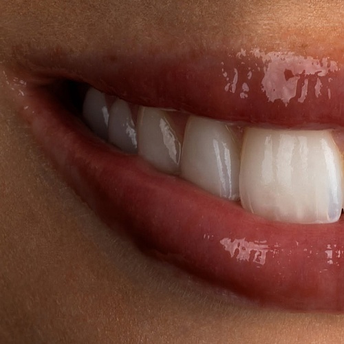 We removed old composite veneers and replaced them with handcrafted porcelain veneers for a more natural, refined...