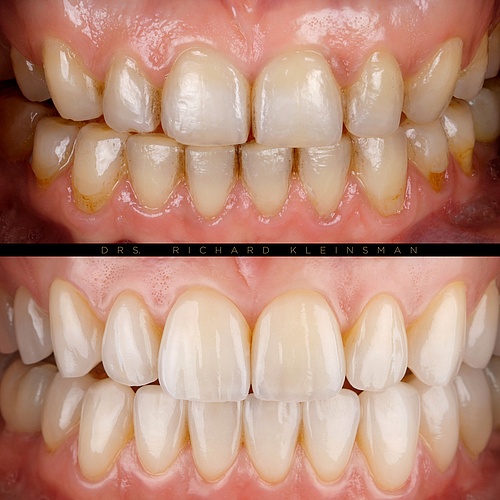 New fresh and natural smile by veneers! Total renovation without damaging the old teeth! . . Dentist:...