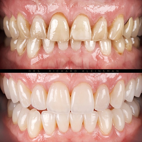 12 new veneers and 16 crowns! . . Dentist: @drs.richardkleinsman Technician: @mike_richterbl . . 📸:...
