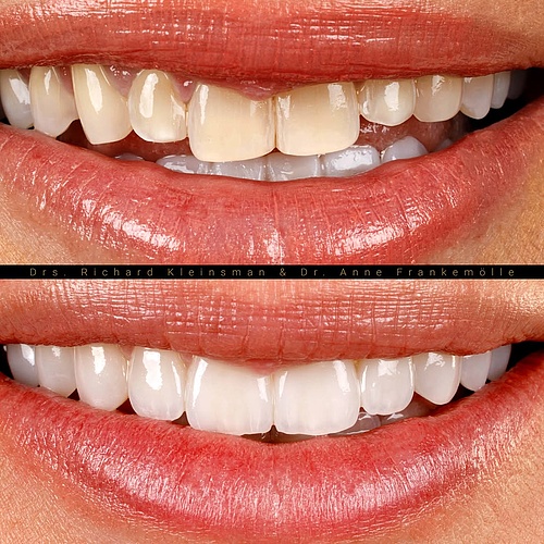 A smile should feel natural, balanced and timeless. . . Dentist: @drs.richardkleinsman Co-Dentist: @annefrankemolle... A smile should feel natural, balanced and timeless. . . Dentist: @drs.richardkleinsman Co-Dentist: @annefrankemolle...