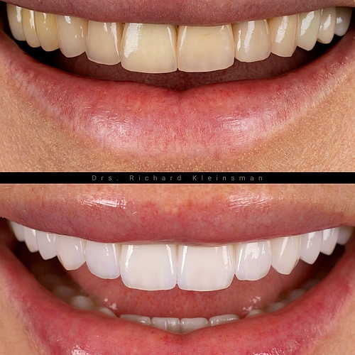 A full upper and lower jaw restoration, completed in just three appointments! This case involved 28 new crowns in... A full upper and lower jaw restoration, completed in just three appointments! This case involved 28 new crowns in...