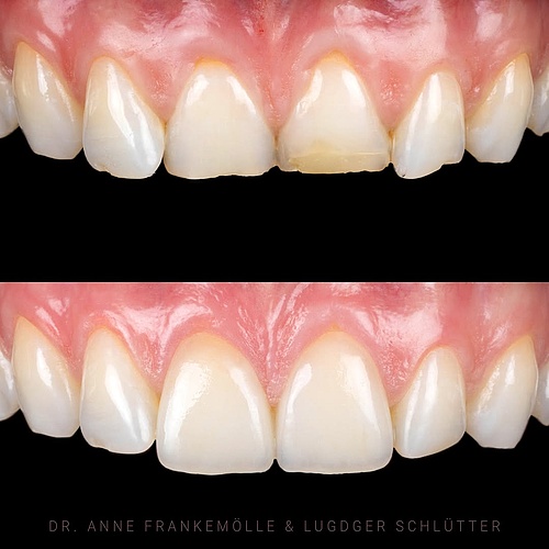 Precise contouring of the gingival margins in mesial and distal areas of the centrals enhanced the natural emergence...