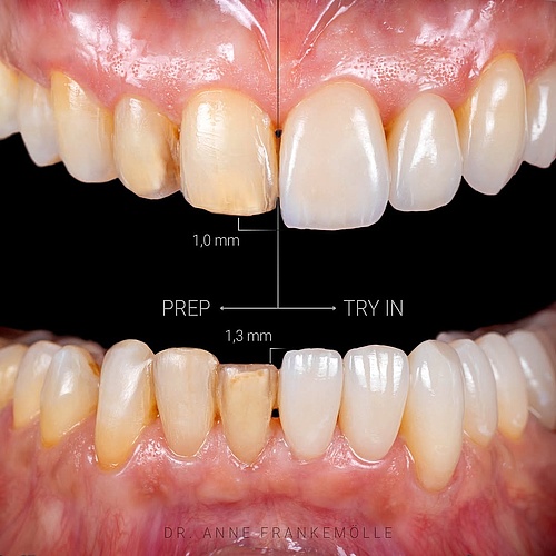 Minimal Invasive Full-Mouth Rehabilitation Restoring form & function — with maximum esthetics and minimal intervention. ...