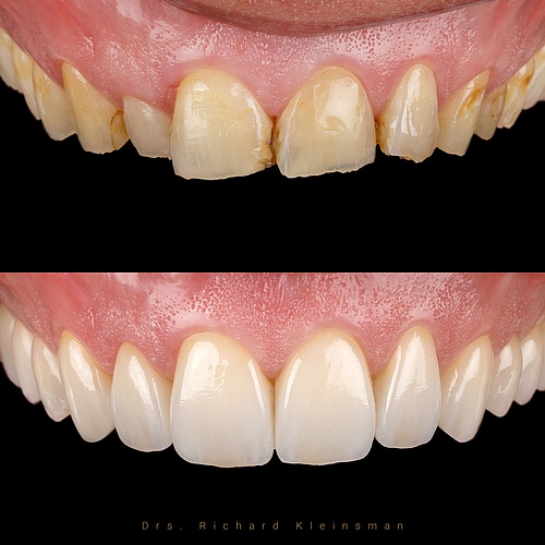 Ceramic restoration after 30 years of grinding. Changed the color, position and function. . . Dentist:...