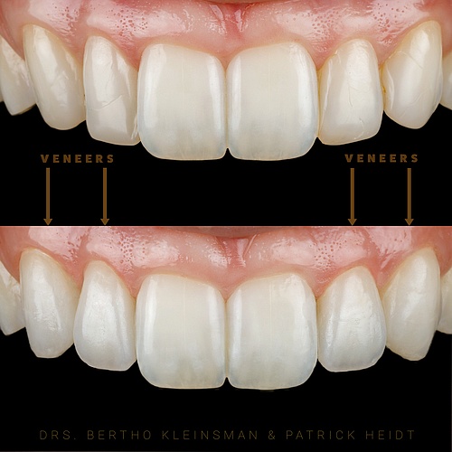 In this case, we have created a uniform shape with only four non prep veneers without damaging the enamel. The anterior...