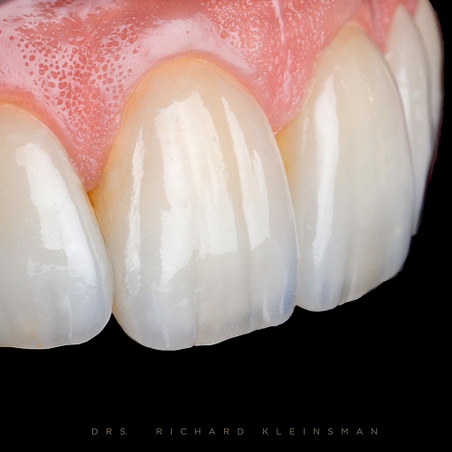 Dental veneers . . Dentist: @drs.richardkleinsman Technician: @mike_richterbl . . #veneers #dentalclinic #dentist...